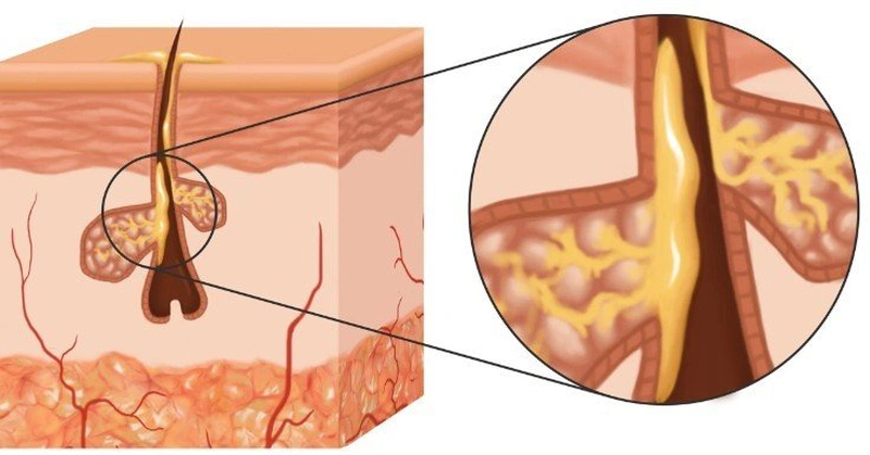 Tuyến bã nhòn hoạt động quá mức